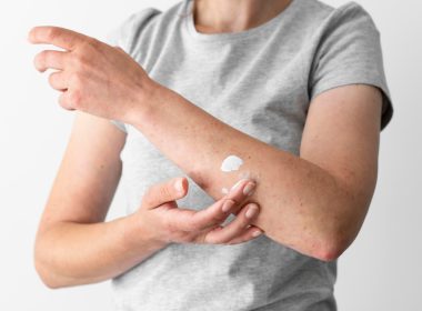 Dermatita atopică
