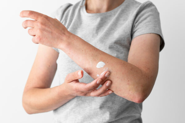 Dermatita atopică